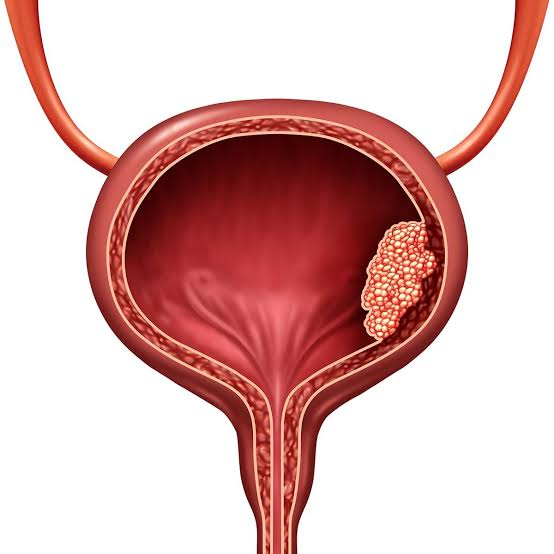 Glucosamine and Interstitial Cystitis: Could It Help Manage Bladder Pain?